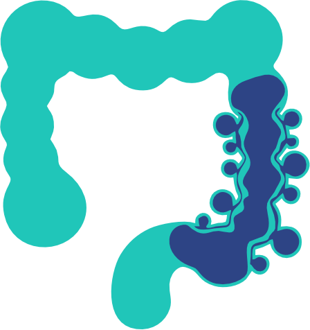 Diverticula / Diverticulitis